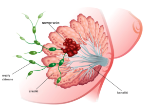 nowotwór piersi schemat onkodiag onkologia