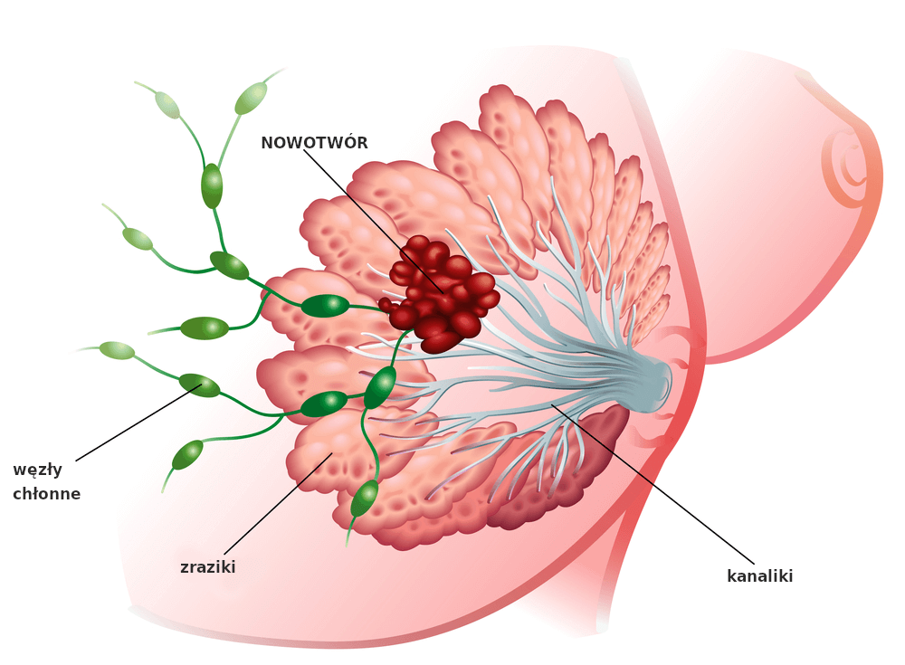nowotwór piersi schemat onkodiag onkologia